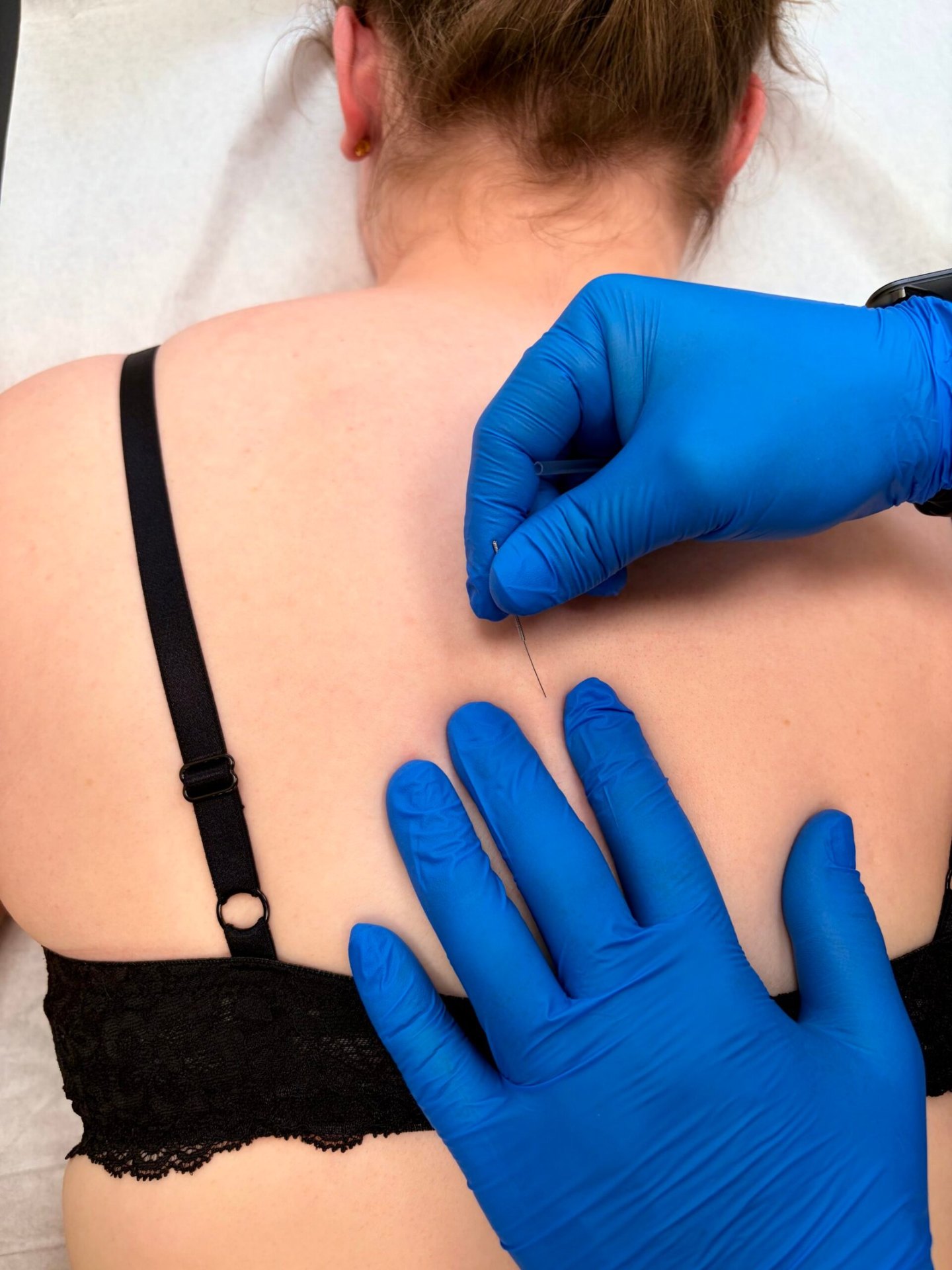 Dry needling behandeling van de rug bij Fysiotherapie Strijp-S in Eindhoven